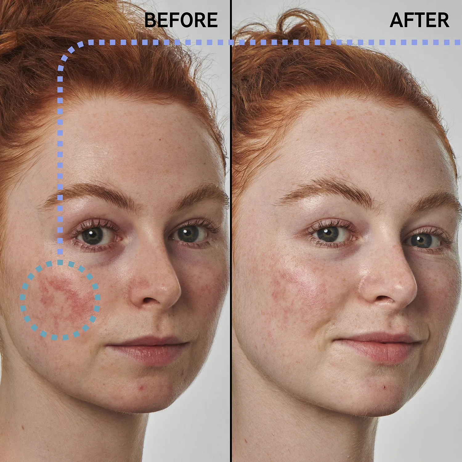 redness solution with 10% azelaic - yüz serumu