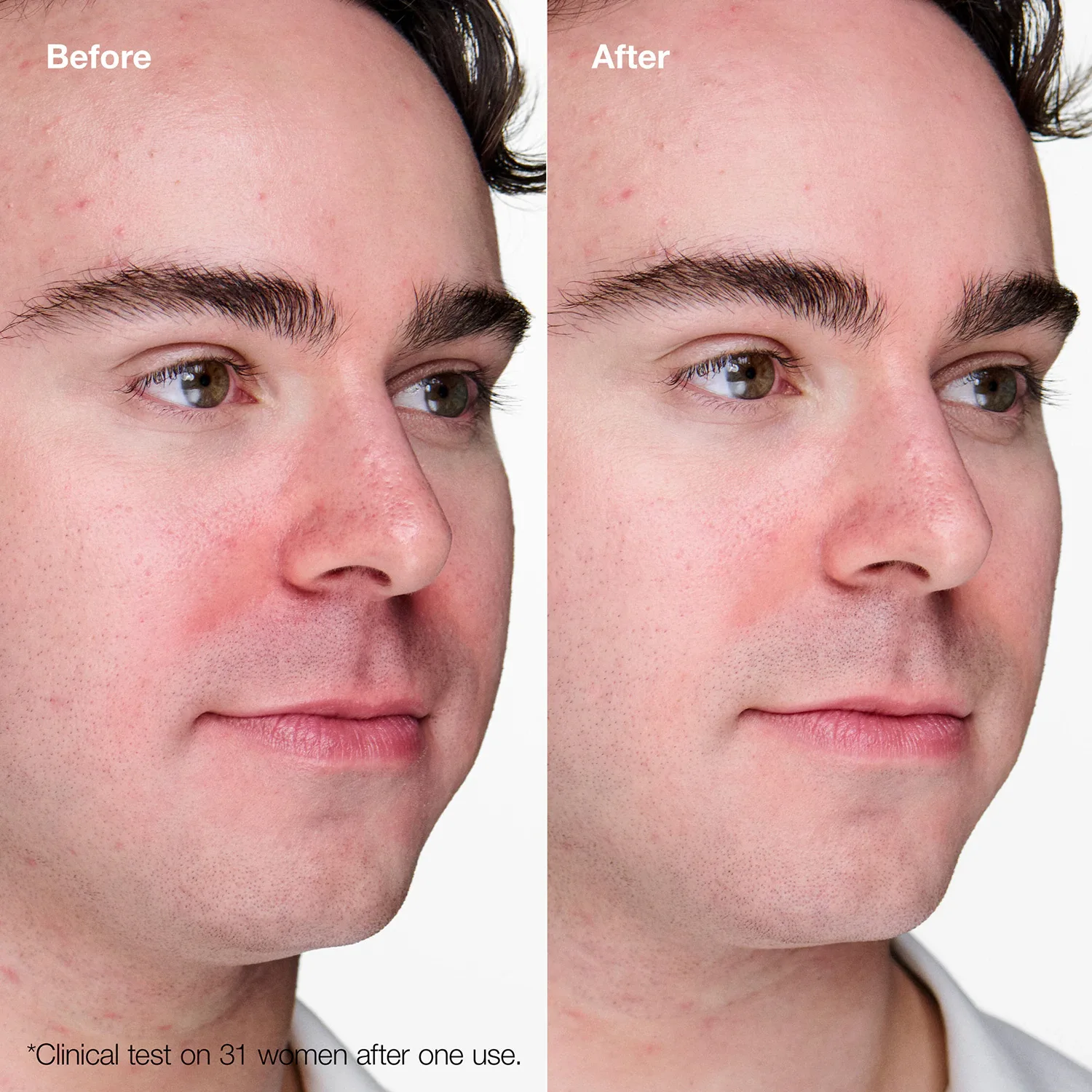anti-blemish solutions - siyah nokta ve sivilce görünümü azaltan bakım jeli