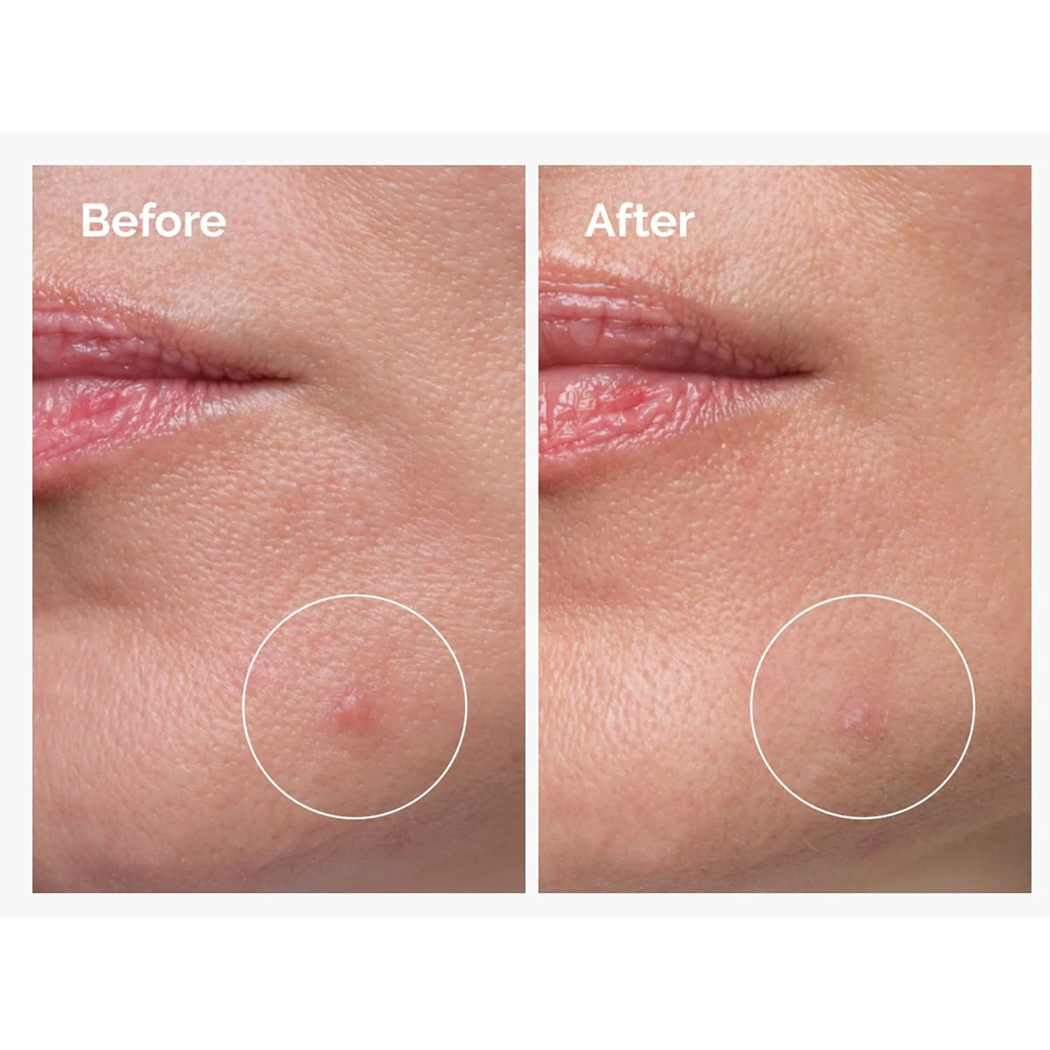sulfur 10% powder-to-cream concentrate – sivilce görünümü karşıtı konsantre toz