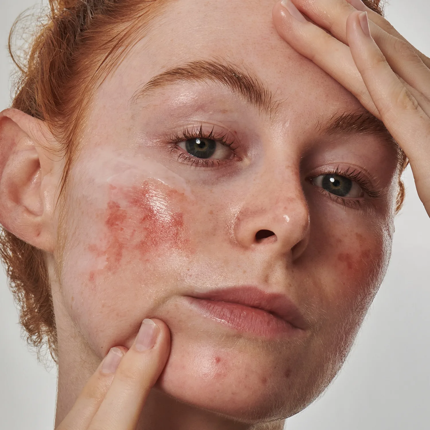 redness solution with 10% azelaic - yüz serumu
