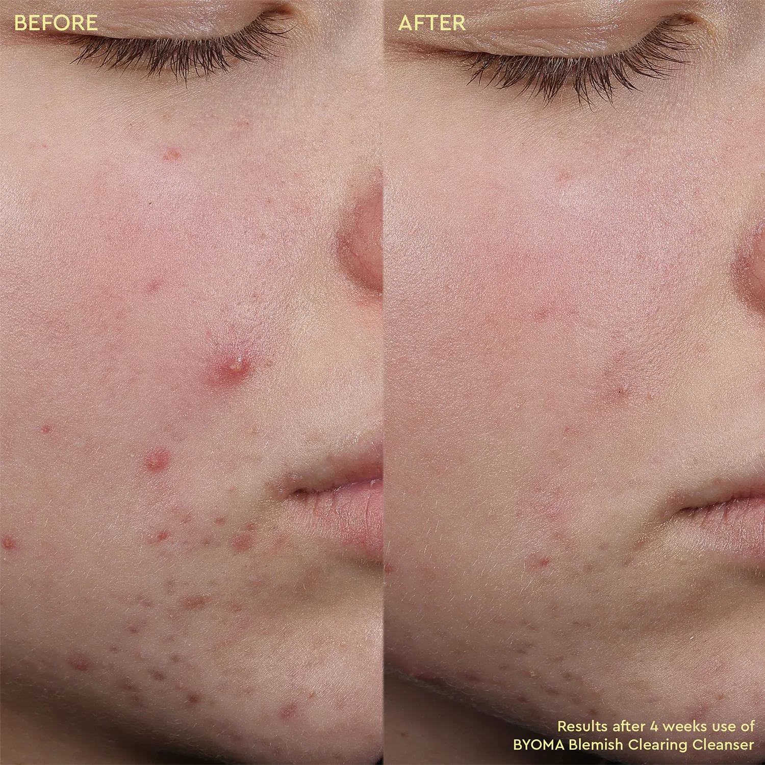 blemish clearing cleanser - cilt kusurları karşıtı temizleyici