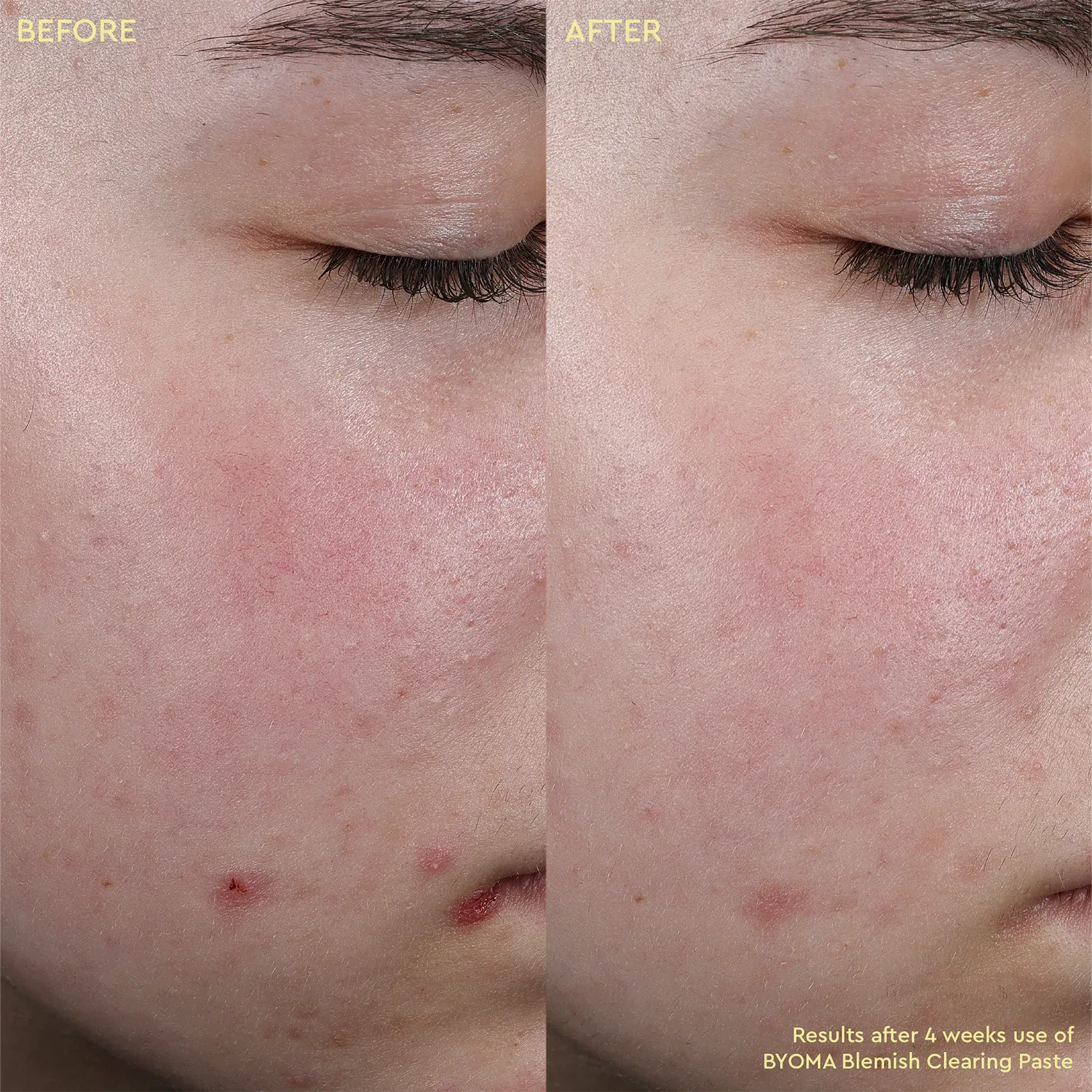 blemish clearing paste - cilt kusurları karşıtı macun