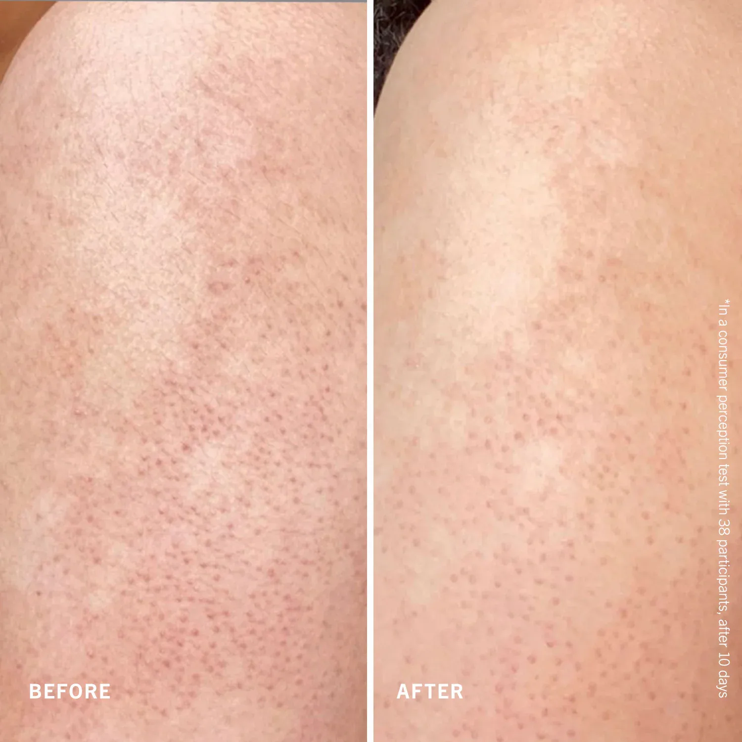 smooth + juicy scrub kit - keratosis pilaris için vücut peeling kiti